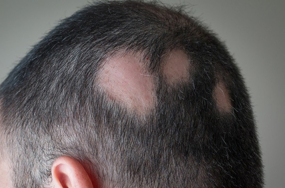 Alopecia areata