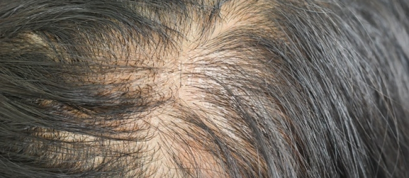 Alopecia diffusa