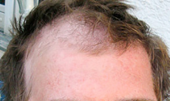 Alopecia