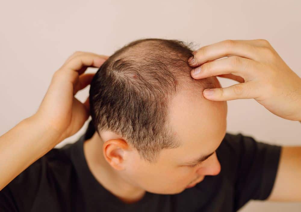 Haarausfall bei Männern